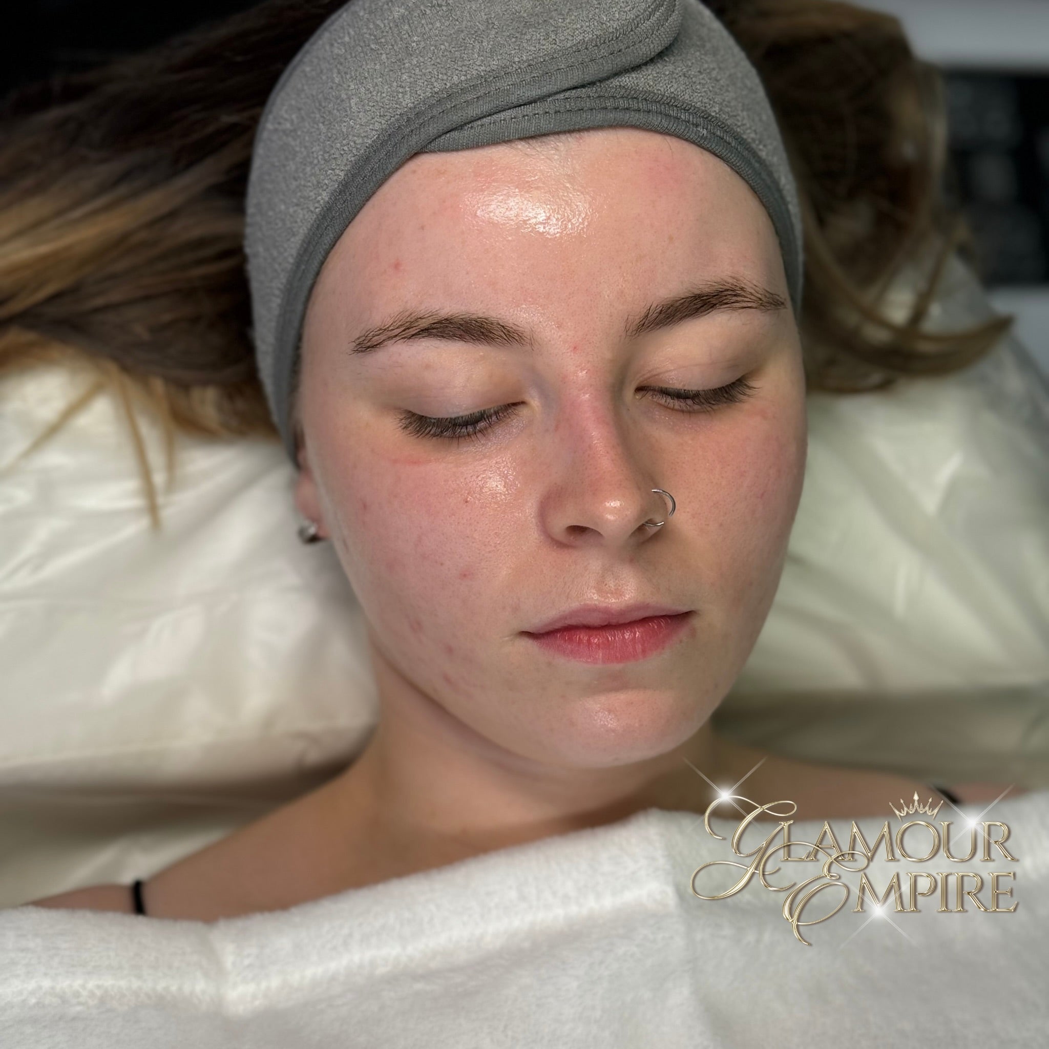 3 Sessions of Chemical Peels