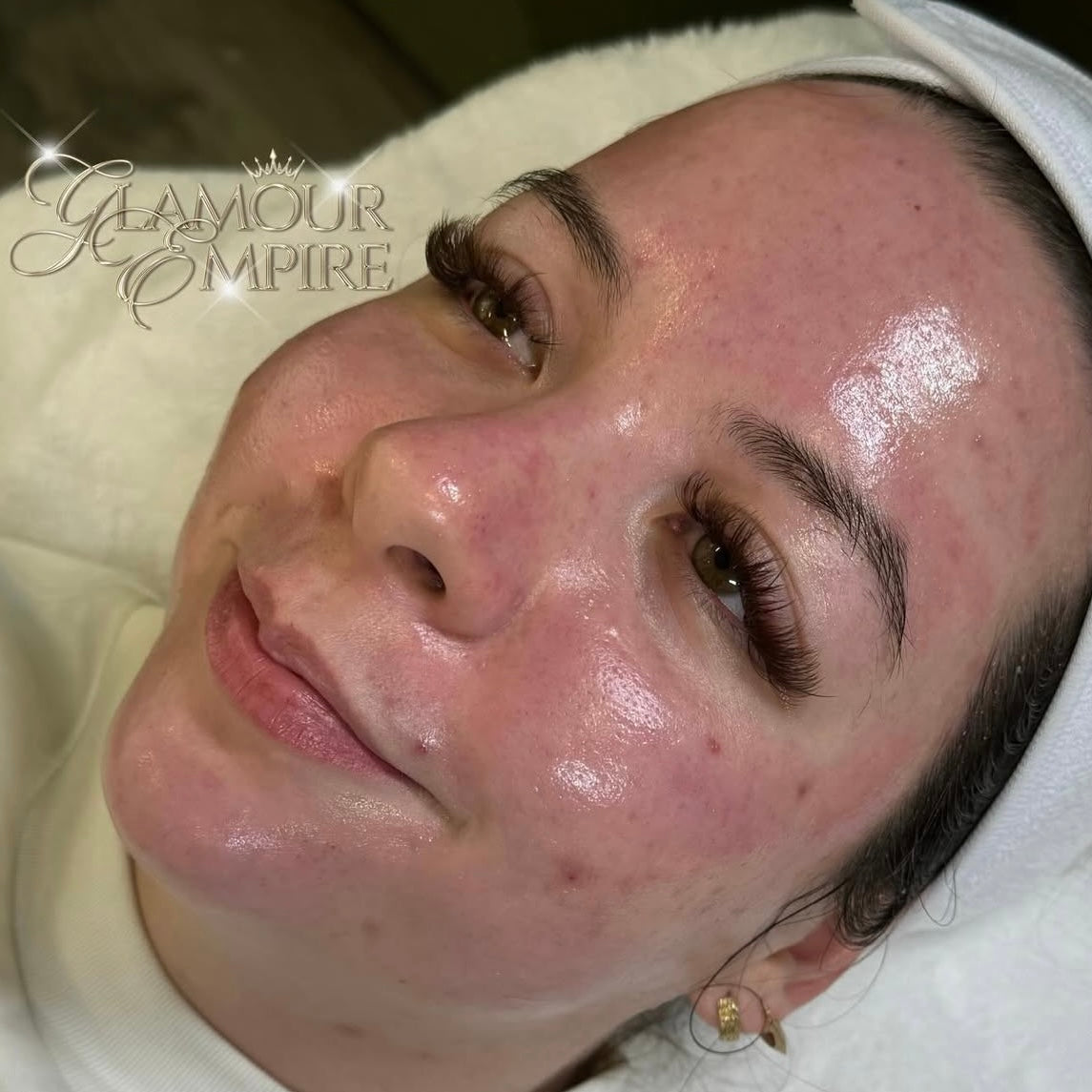 Microneedling