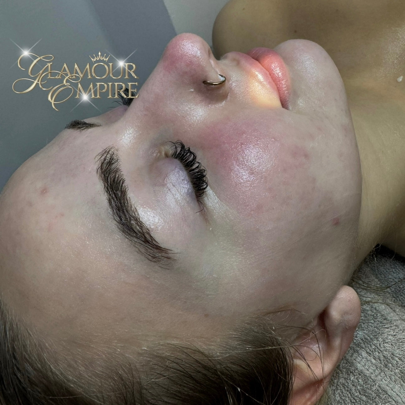 Dermaplaning